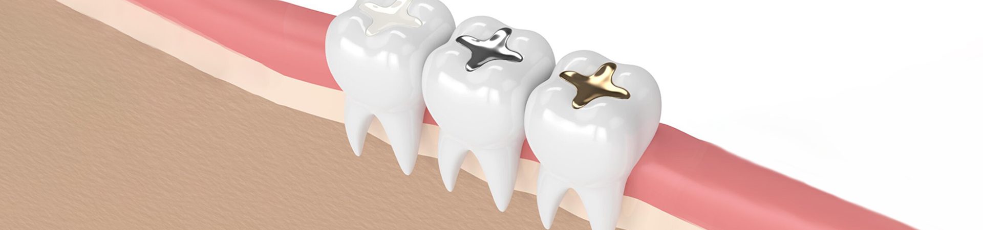 Tooth coloured fillings.