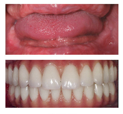 Before and after picture of an implant supported denture patient at Central New England Dental Associates